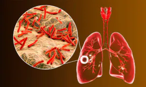 Tuberculosis on the Rise: Here's What to Know About the Disease