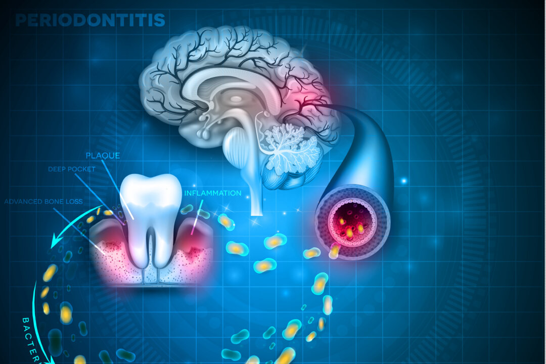 Bacteria from inflamed gums can enter in to the blood stream and affect other organs such as brain. (Shutterstock)