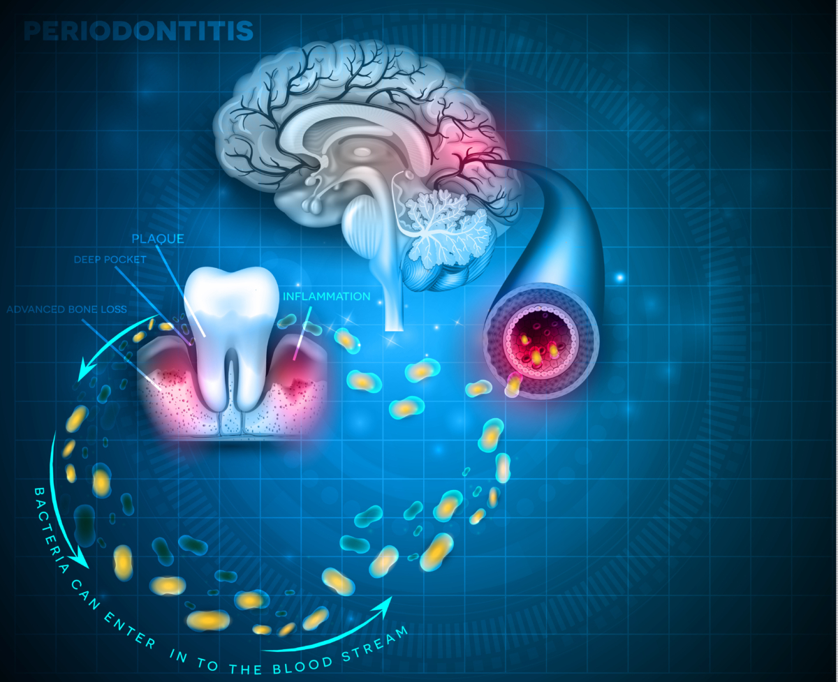 NextImg:An Important and Overlooked Cause of Alzheimer's