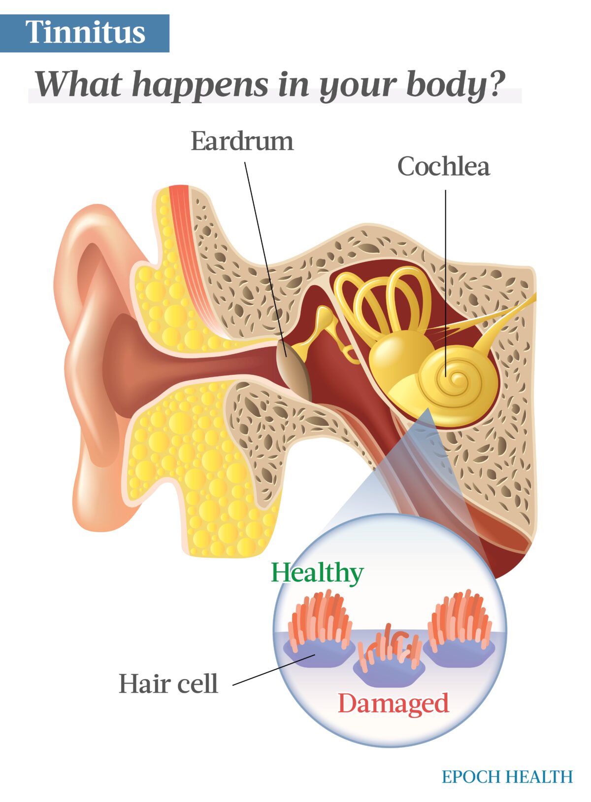 The Essential Guide To Tinnitus Symptoms Causes Treatments And