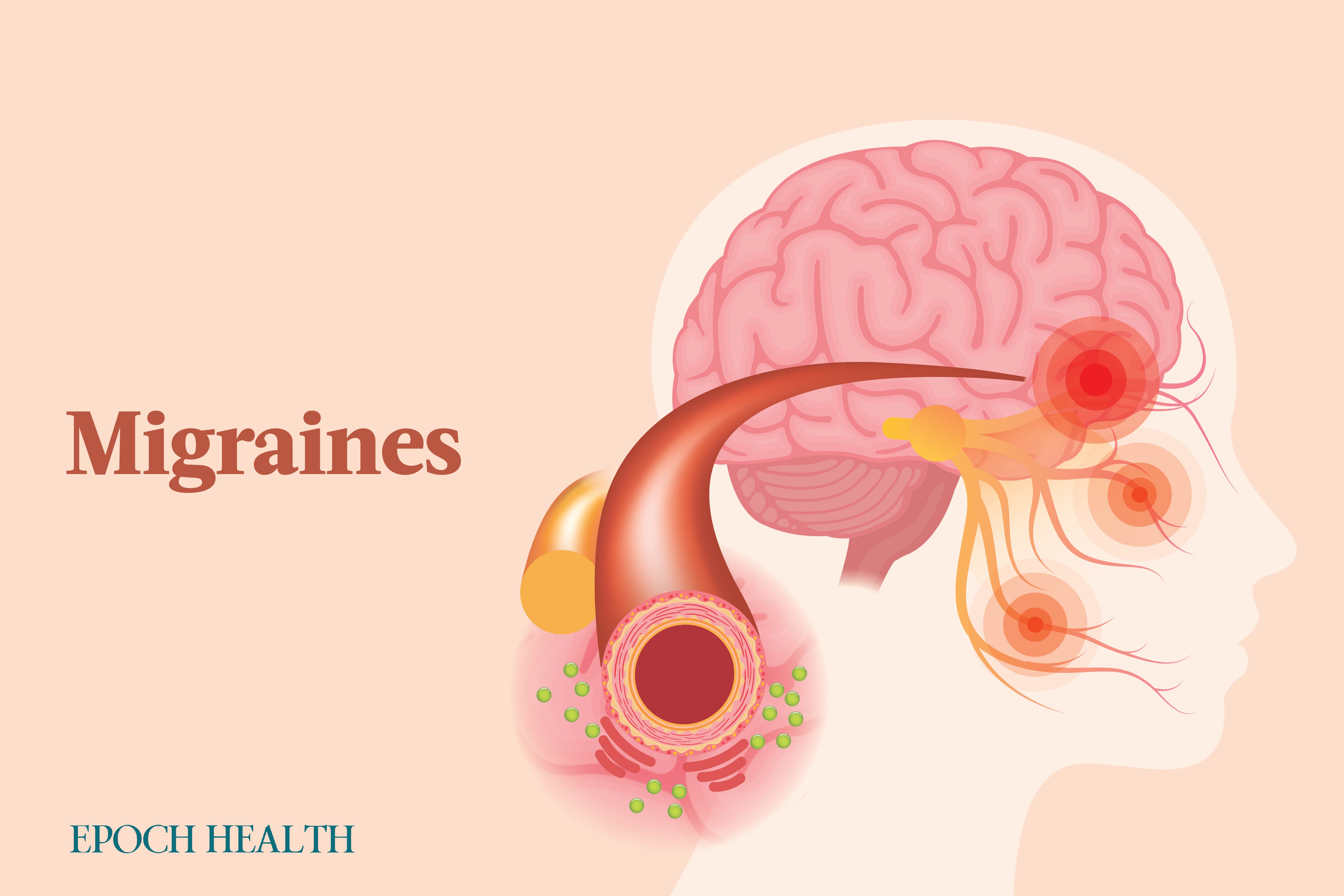 The Essential Guide to Migraines: Symptoms, Causes, Treatments, and Natural Approaches