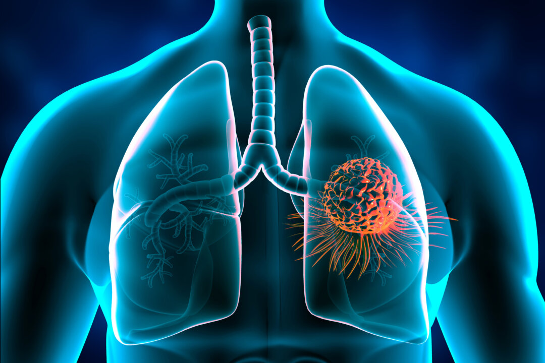 A 3D illustration of lung cancer. (Shutterstock)