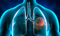 High-Fat Breakfast May Improve Lung Cancer Treatment: Study