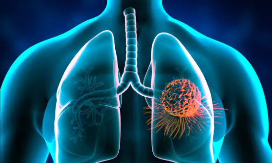 High-Fat Breakfast May Improve Lung Cancer Treatment: Study