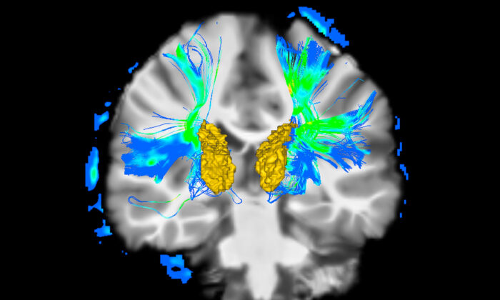 Parkinson’s Disease: 9 Very Early Warning Signs to Be Aware Of