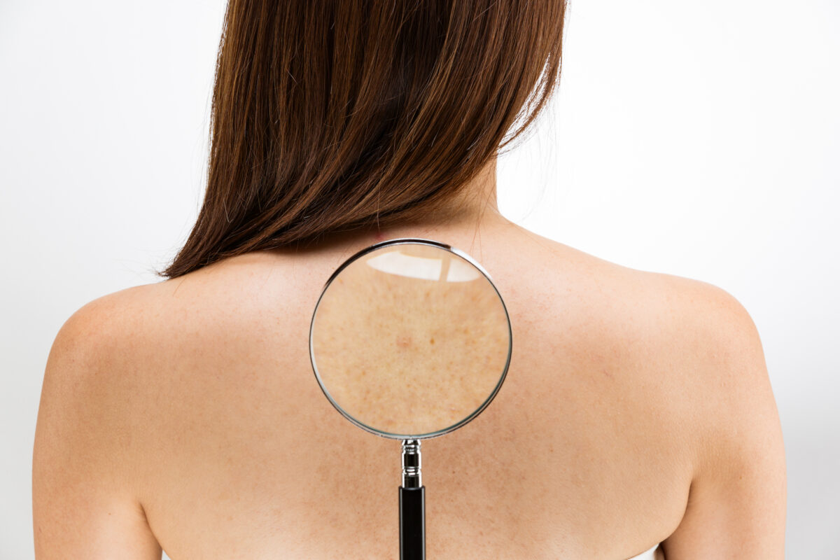 NextImg:Spotting Trouble: A Guide to Identifying Melanoma Skin Cancer