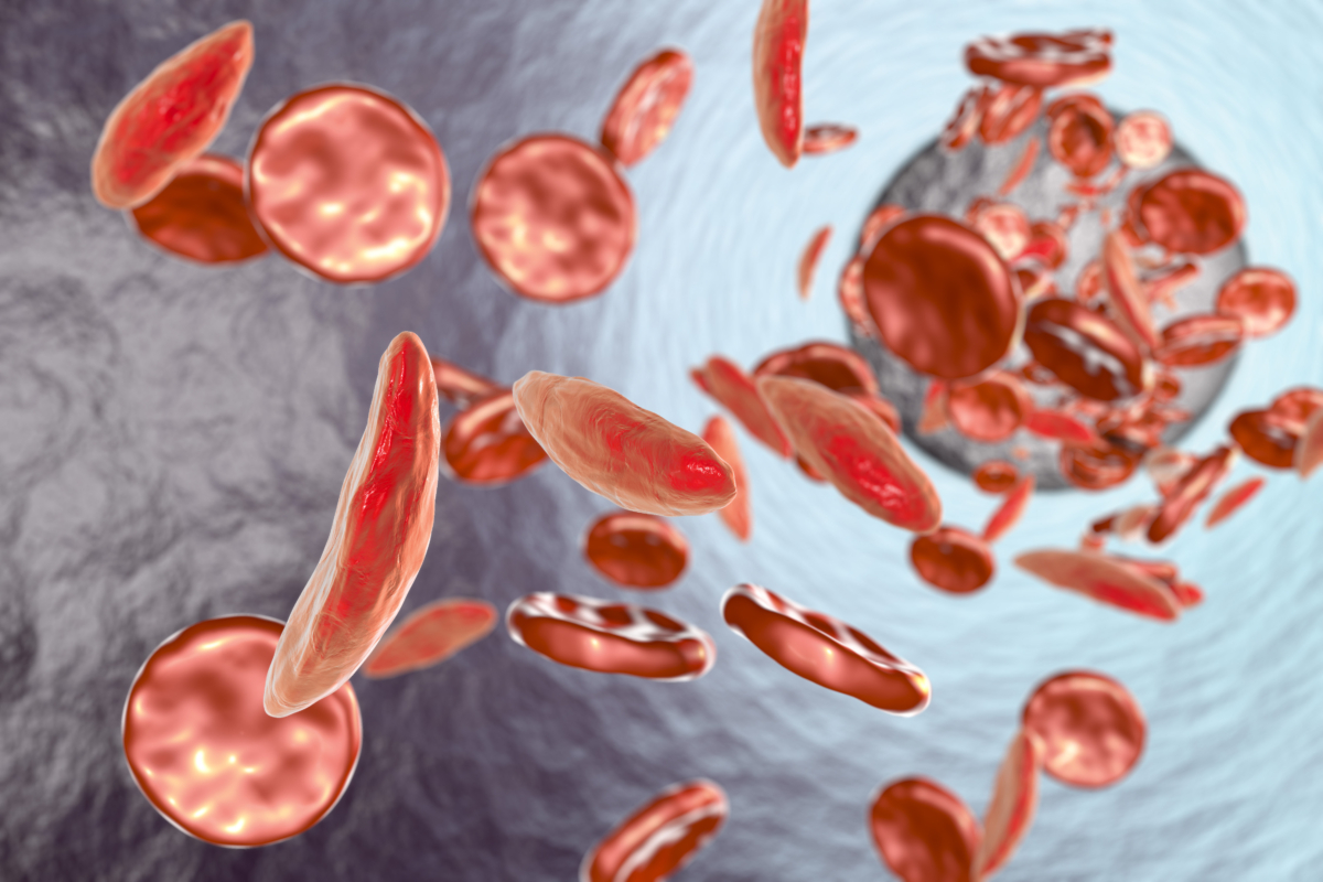 Global Sickle Cell Deaths Eleven Times Higher Than Recorded Reveals Lancet Study