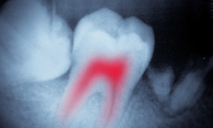 Medical Alert: Root Canal Procedures Threaten Human Health