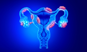 A Surprising Cause of Endometriosis