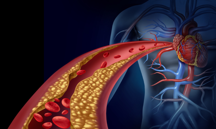 Berberine May Reduce Atherosclerosis