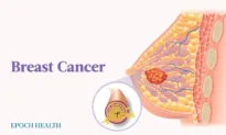 The Essential Guide to Breast Cancer: Symptoms, Causes, Treatments, and Natural Approaches