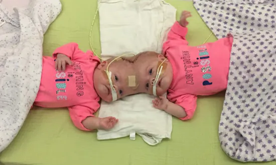 ‘One-in-2.5 Million’ Conjoined Twin Girls Who Survived Separation Surgery Graduate From Kindergarten: PHOTOS