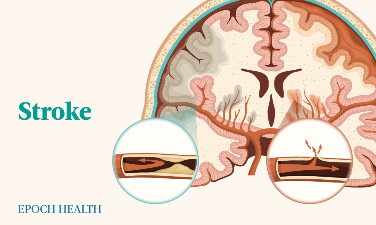 The Essential Guide to Stroke: Symptoms, Causes, Treatments, and Natural Approaches