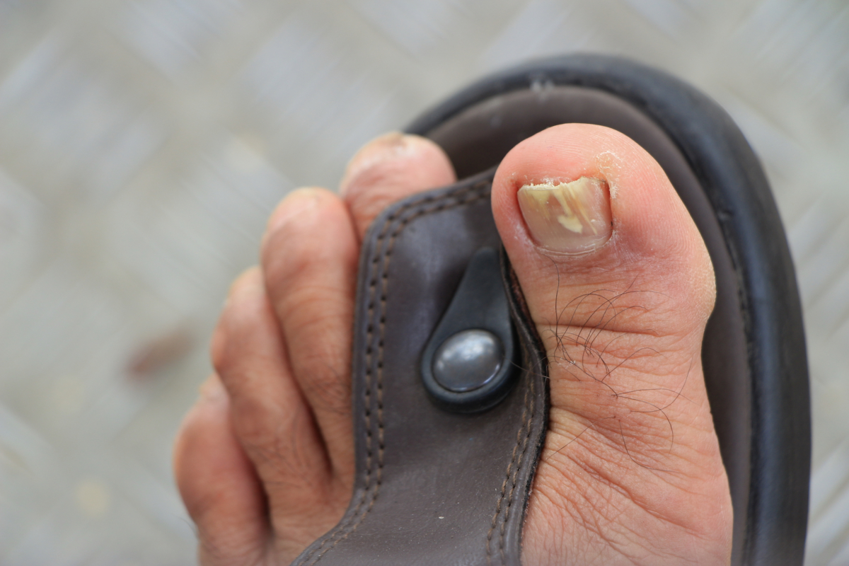 Cracked and Brittle Toenails? Fight Back Against Fungal Nail Infections With These Tips