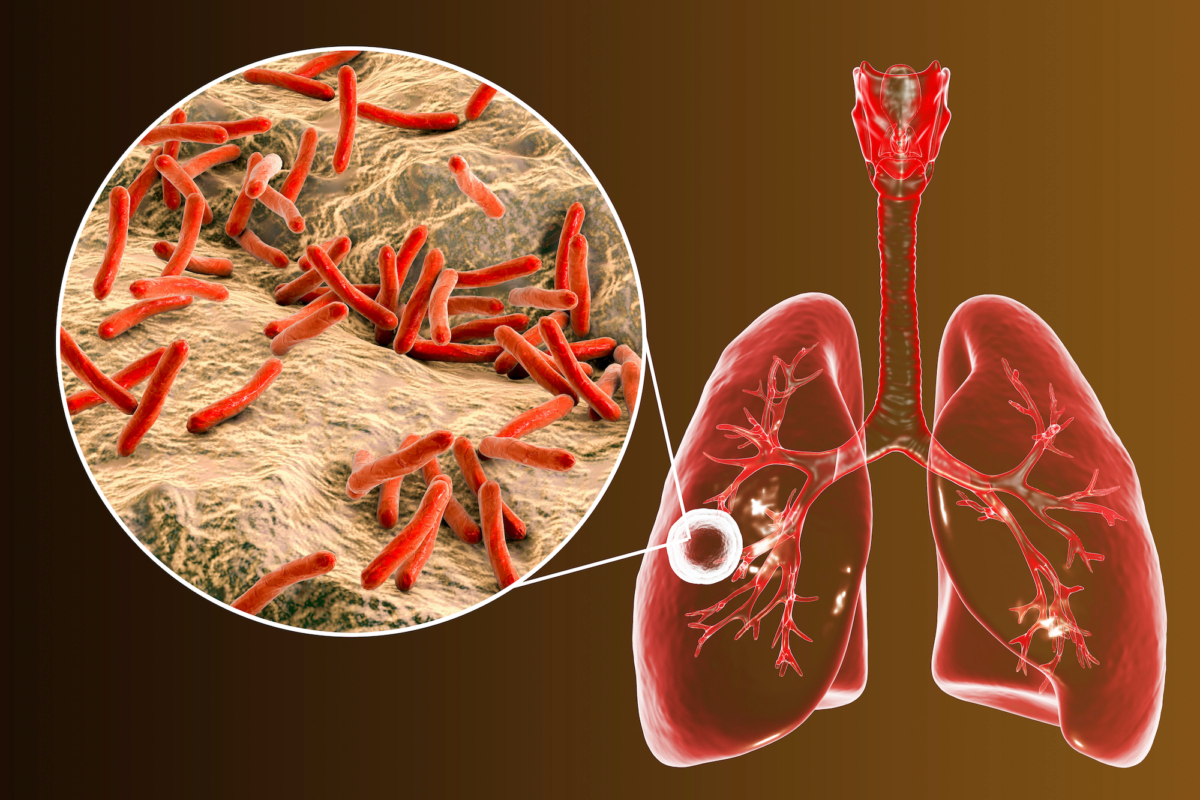 Major Setback in Shortened Tuberculosis Treatment as Clinical Trial Fails