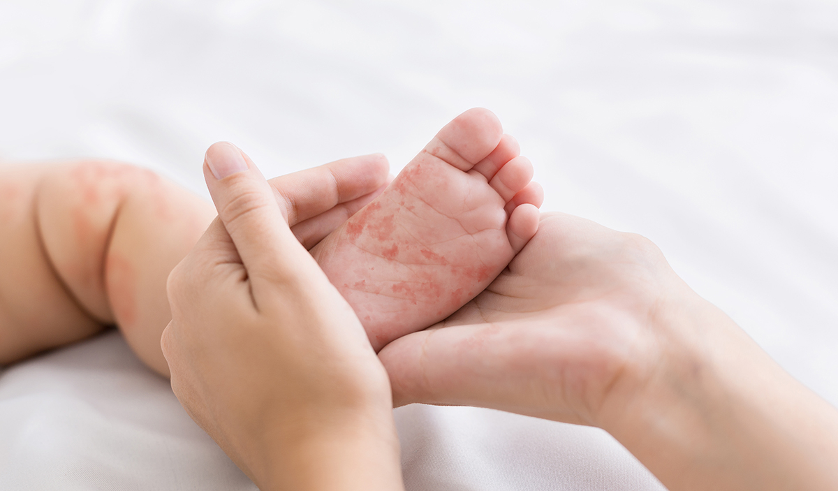 Measles Making a Comeback, and It's Never Really Gone
