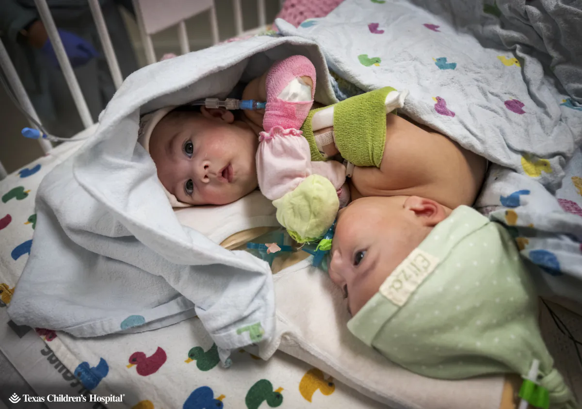 Conjoined twins Ella Grace and Eliza Faith Fuller were born at Texas Children's Hospital in Houston, Texas, on March 1, 2023. (Texas Children's Hospital) 