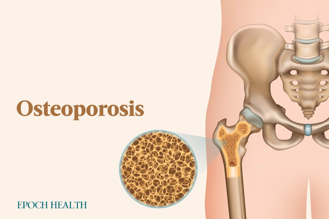 Osteoporosis is a "silent" disease that you may not detect until you fracture a bone. (The Epoch Times)