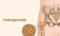 The Essential Guide to Osteoporosis: Symptoms, Causes, Treatments, and Natural Approaches