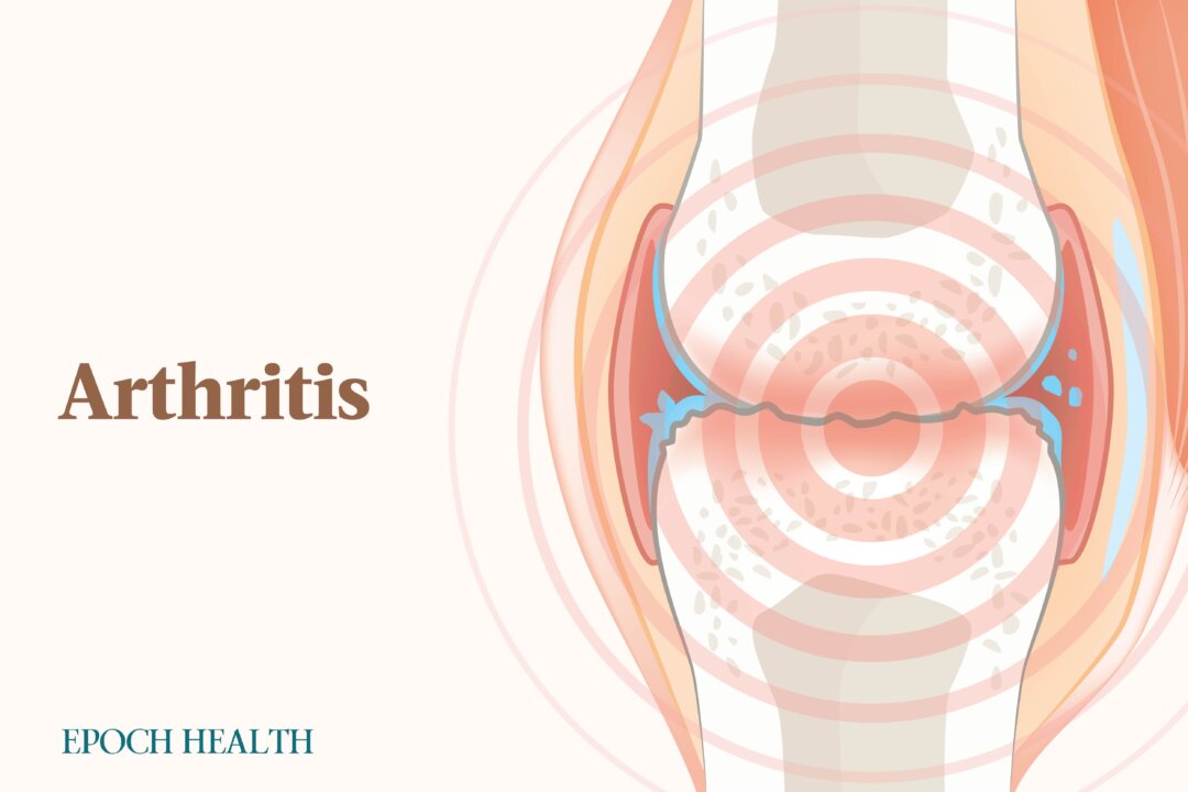 Arthritis is a joint disorder that is the most common cause of disability in the United States. (The Epoch Times)