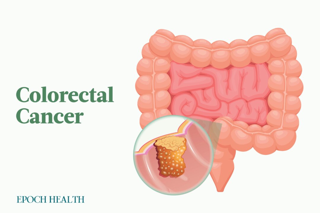 Colorectal cancer is on the rise in people under 50. (The Epoch Times)