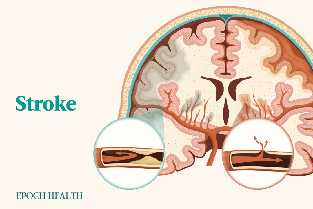 Four out of five strokes are preventable. (The Epoch Times)
