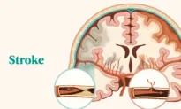 The Essential Guide to Stroke: Symptoms, Causes, Treatments, and Natural Approaches