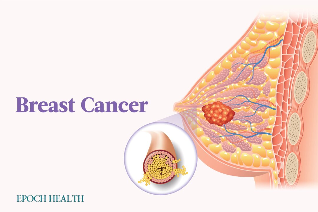 Breast cancer accounts for 1 in 3 of all newly diagnosed women’s cancers annually. (The Epoch Times)