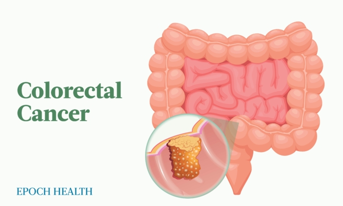 The Essential Guide to Colorectal Cancer: Symptoms, Causes, Treatments, and Natural Approaches 