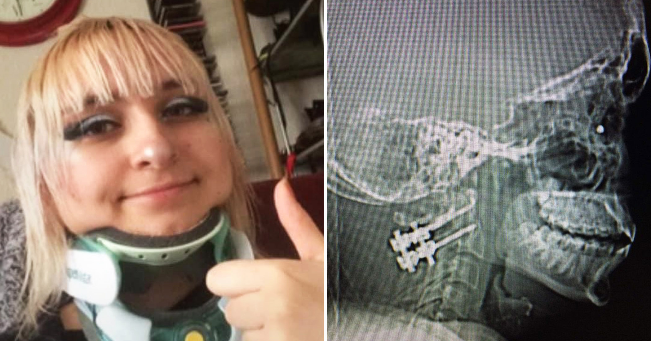 Woman who fell 12 feet fracturing her neck during a cigarette break says, 'It's a miracle I'm alive'