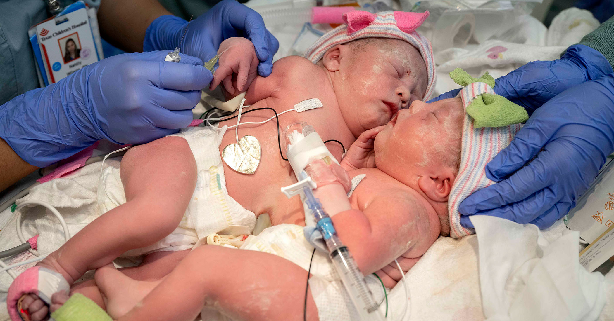 NextImg:Happy homecoming for conjoined twins after a complex 6-hour separation surgery