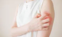 Long COVID Causes Skin Allergies and Itching, Tips for Alleviating Symptoms