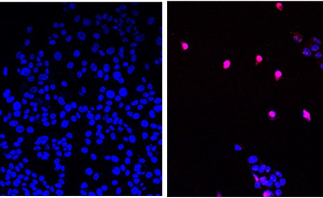 The City of Hope-developed small molecule AOH1996 targets a cancerous variant of the protein PCNA. In its mutated form, PCNA is critical in DNA replication and repair of all expanding tumors. Image shows untreated cancer cells (L) and cancer cells treated with AOH1996 (R) undergoing programmed cell death (violet). (Courtesy of City of Hope)