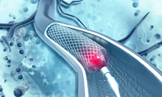 Angioplasty Heart Stent Risks Versus Benefits