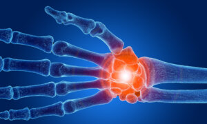 Chronic Wrist Pain: Can Last for Years, a Therapist’s Top Exercises to Relieve