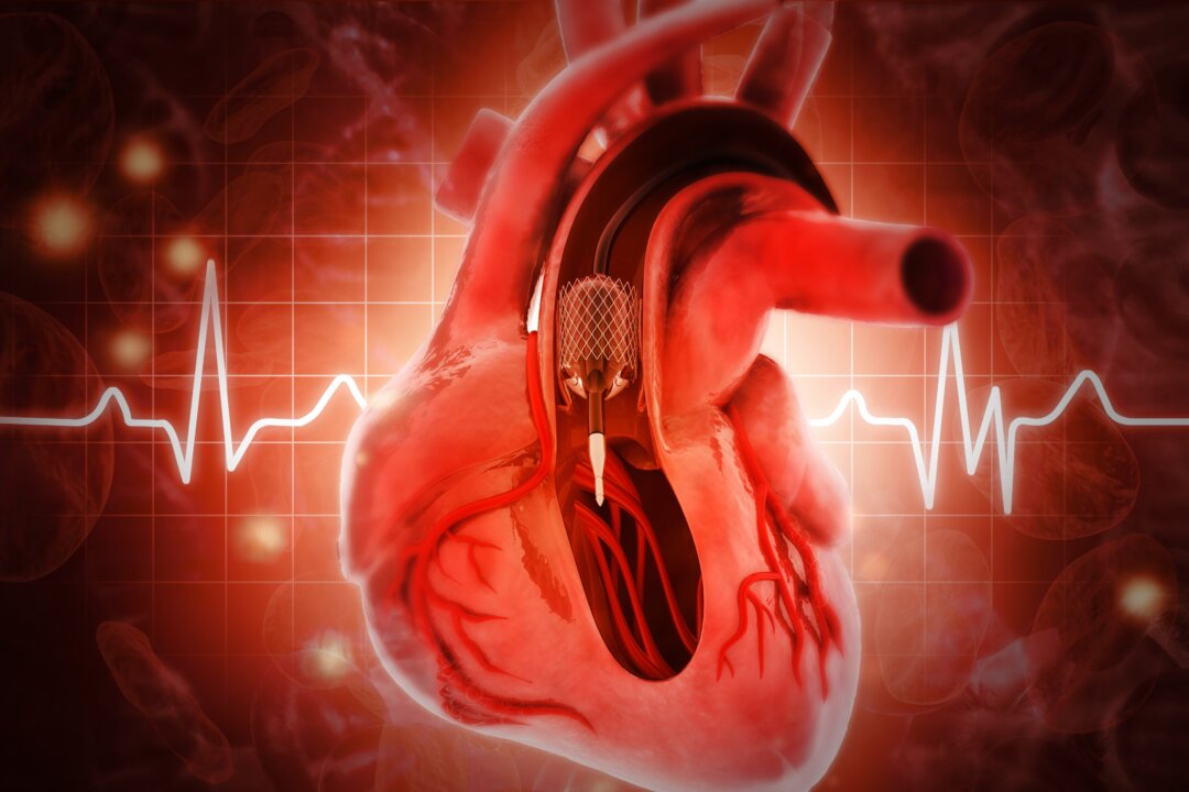 Do Heart Stent Procedures Work for Angina Chest Pain?