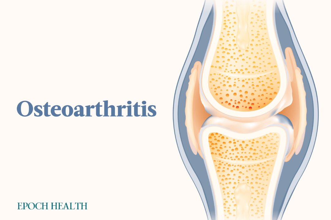 Osteoarthritis is among the leading causes of disability in the United States. (The Epoch Times)