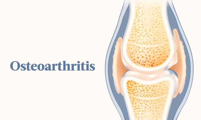 The Essential Guide To Osteoarthritis: Symptoms, Causes, Treatments 