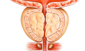 Manage Your Enlarged Prostate With These Tips
