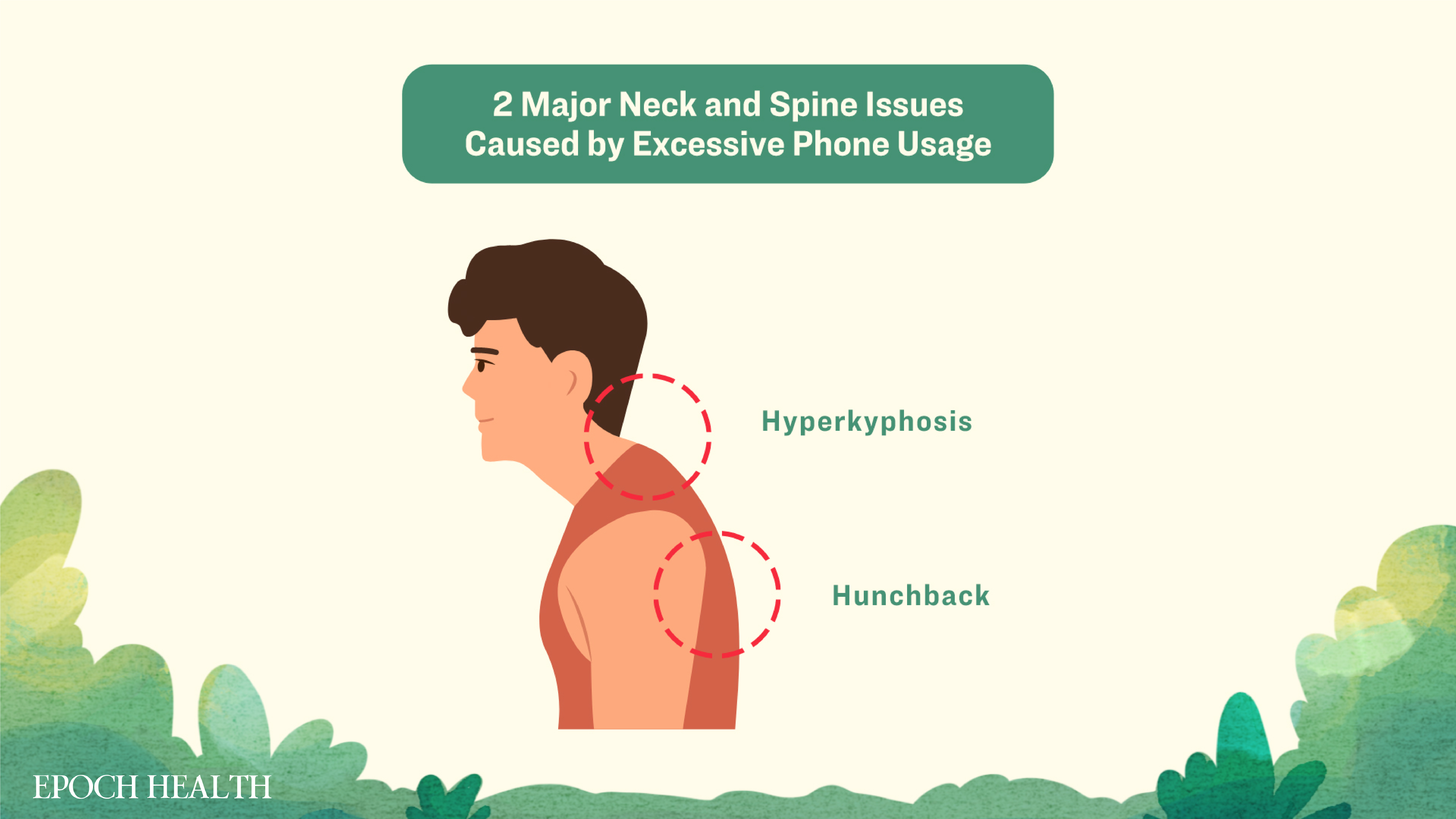 Common neck issues associated with excessive mobile phone usage: hyperkyphosis and hunchback. (The Epoch Times)