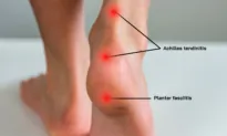 Achilles Tendinitis: Symptoms, Causes, and Treatment
