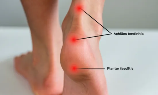 Achilles Tendinitis: Symptoms, Causes, and Treatment