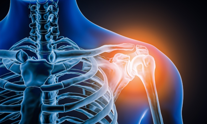 Major Cause of Shoulder Impingement