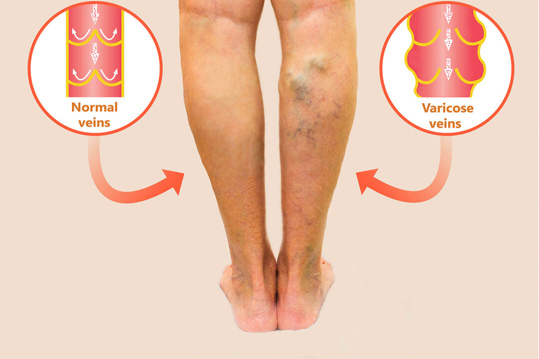 Varicose veins affect both appearance and health. (Solarisys/Shutterstock)