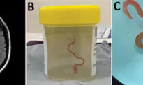 ‘Alive and Wriggling’: 8 Centimetre Worm Extracted From Woman’s Brain