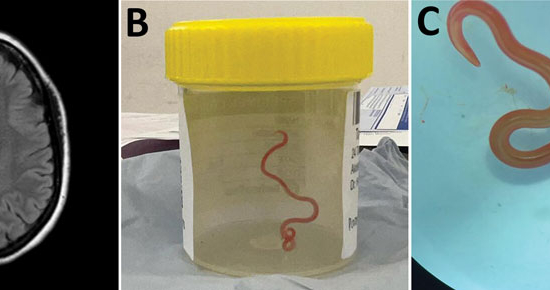 'Alive and Wriggling': 8 Centimetre Worm Extracted From Woman's Brain