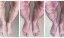 Purplish Discoloration of the Legs: An Unusual Long-COVID Symptom