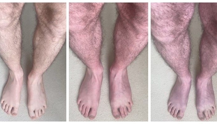 Purplish Discoloration Of The Legs An Unusual Long Covid Symptom The