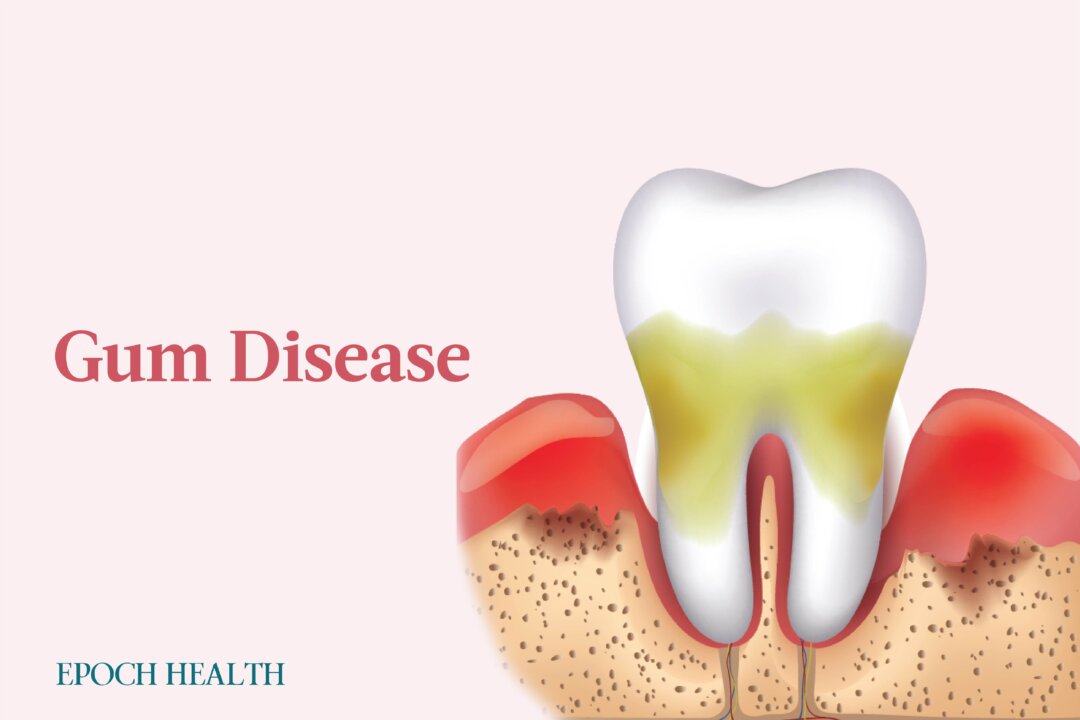 Gum disease is one of the most common diseases in the world. (Illustrations from Shutterstock/Designed by The Epoch Times)