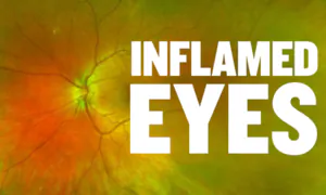 Study: COVID-19 Vaccine Caused Rare ‘White Dot Syndrome’